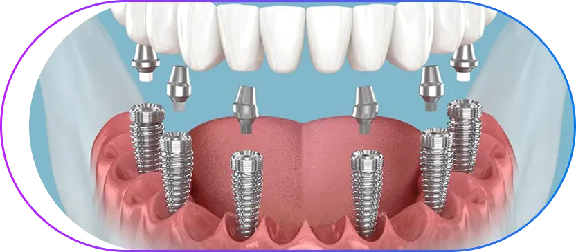All-on-6 Dental Implants in Kolkata All-on-6 Dental Implants in Kolkata