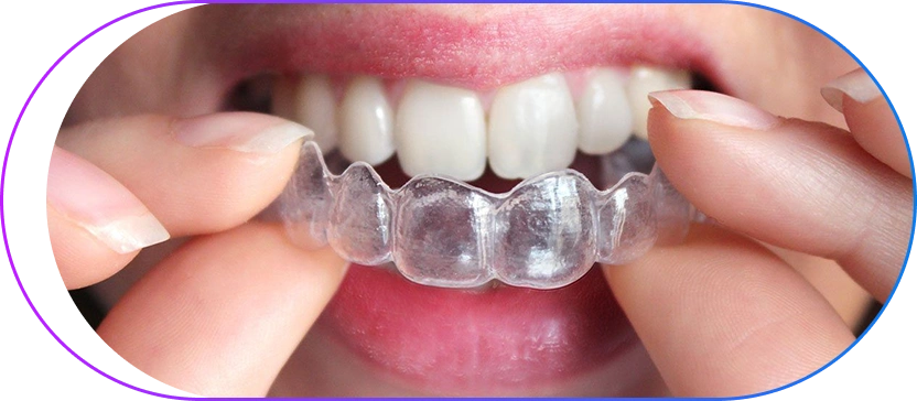 Invisible Dental Braces in Kolkata