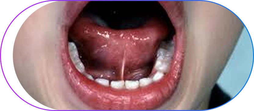 Tongue Tie (Ankyloglossia) Treatment in Kolkata
