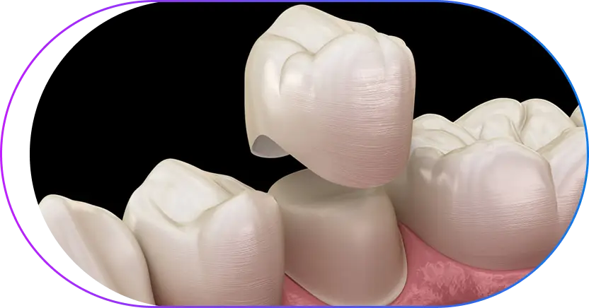 Your Crown Options Your Crown Options