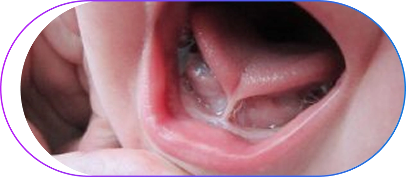 Tongue Tie Treatment Options