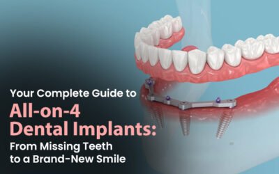 Your Complete Guide to All-on-4 Dental Implants: From Missing Teeth to a Brand-New Smile