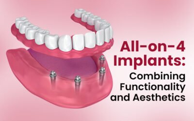 All-on-4 Implants: Combining Functionality and Aesthetics