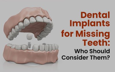 Dental Implants for Missing Teeth: Who Should Consider Them?