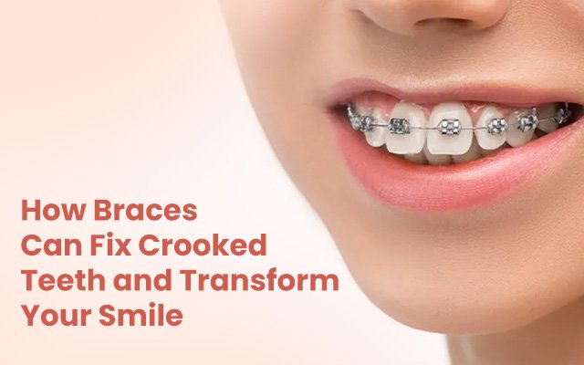 How Braces Can Fix Crooked Teeth