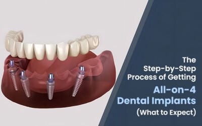 The Step-by-Step Process of Getting All-on-4 Dental Implants (What to Expect)
