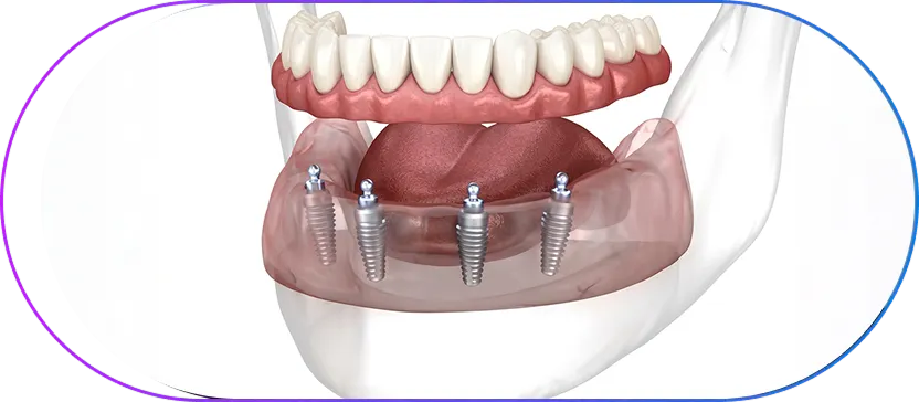 Implant Overdenture