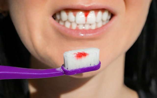 Bleeding Gums While Brushing? This Is Not Normal — It’s Your First Warning Sign