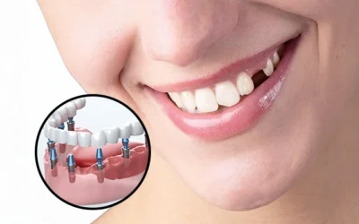 The Benefits of Dental Implants: Why They’re the Best Choice for Replacing Missing Teeth