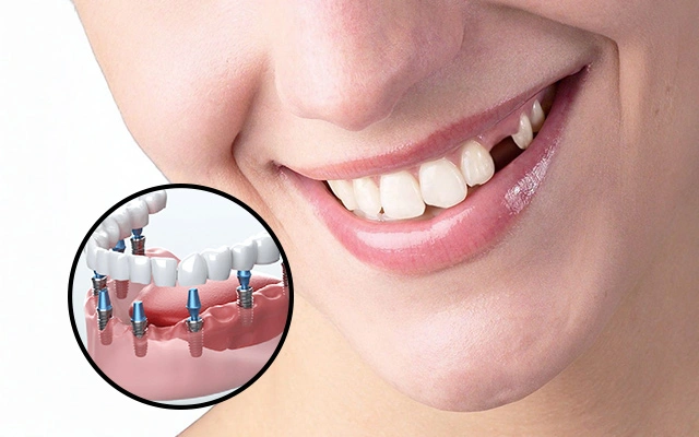 The Benefits of Dental Implants Why They’re the Best Choice for Replacing Missing Teeth