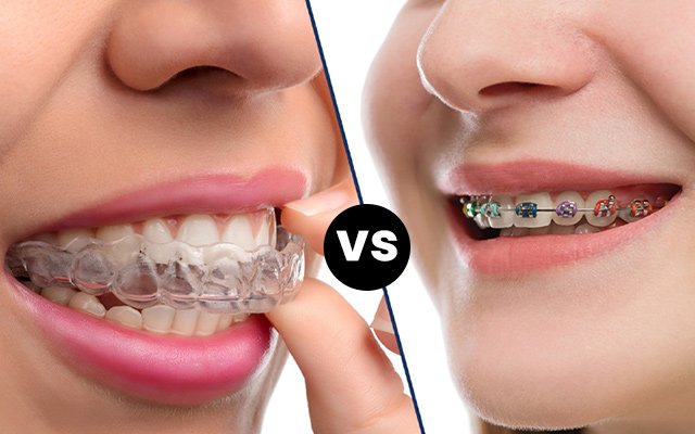 Invisalign vs Traditional Braces