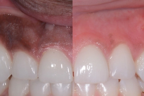 Gum Depigmentation