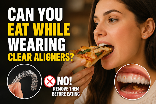 Clean Your Aligners Before Eat