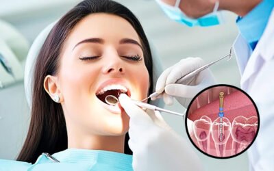10 Signs You May Need Root Canal Treatment Before the Infection Gets Worse
