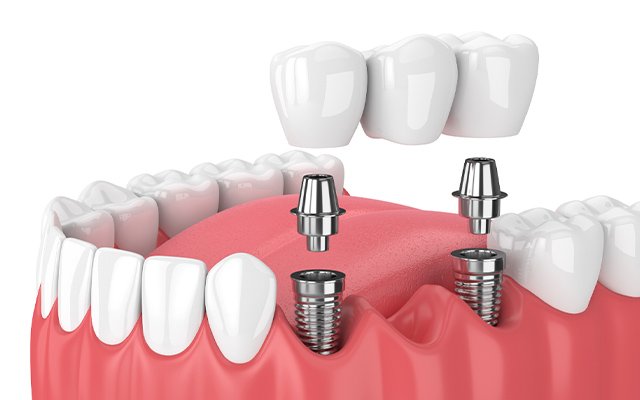 What Causes Tooth Loss? 10 Reasons Dentists Commonly See